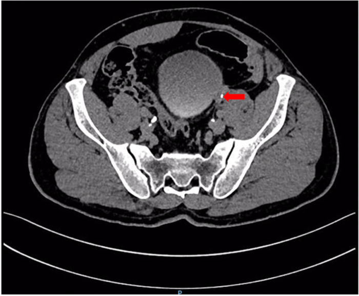 The ureter is indicated by